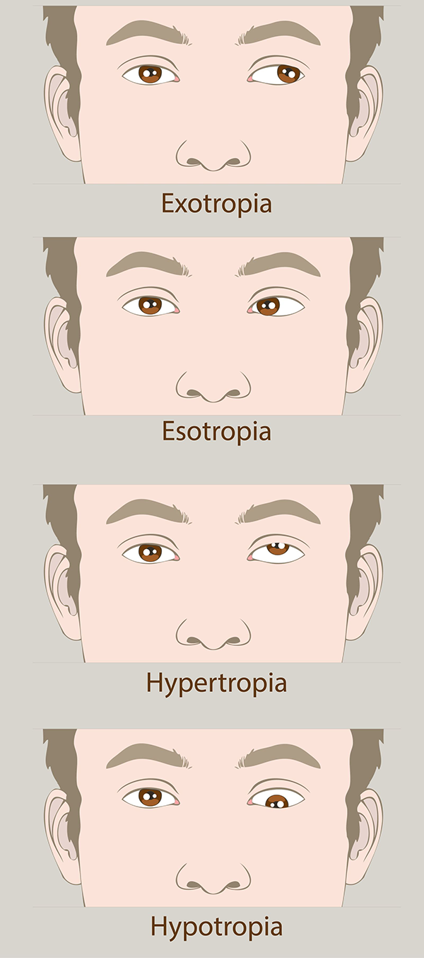 Larchmont Amblyopia