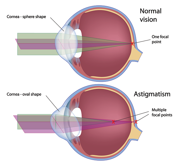 Astigmatism Larchmont