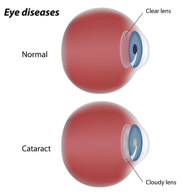 Cataract Treatment Larchmont