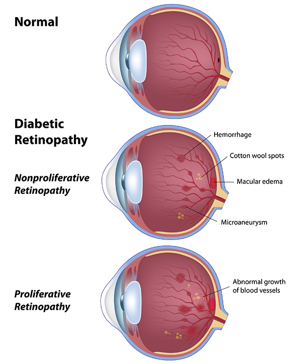 symptoms of diabetic retinopathy Larchmont