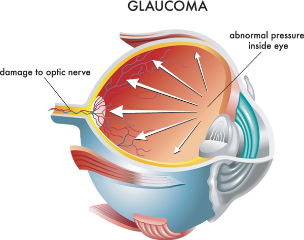 10538 Glaucoma