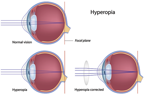 10538 Farsightedness