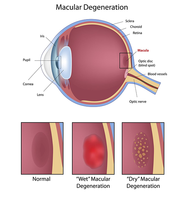 10538 Macular Degeneration