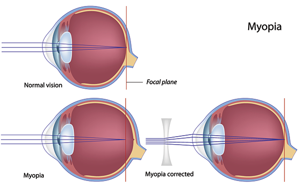 Nearsightedness Larchmont