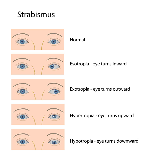 Strabismus Treatment 10538