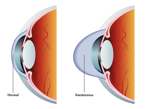 Keratoconus Treatment in Larchmont